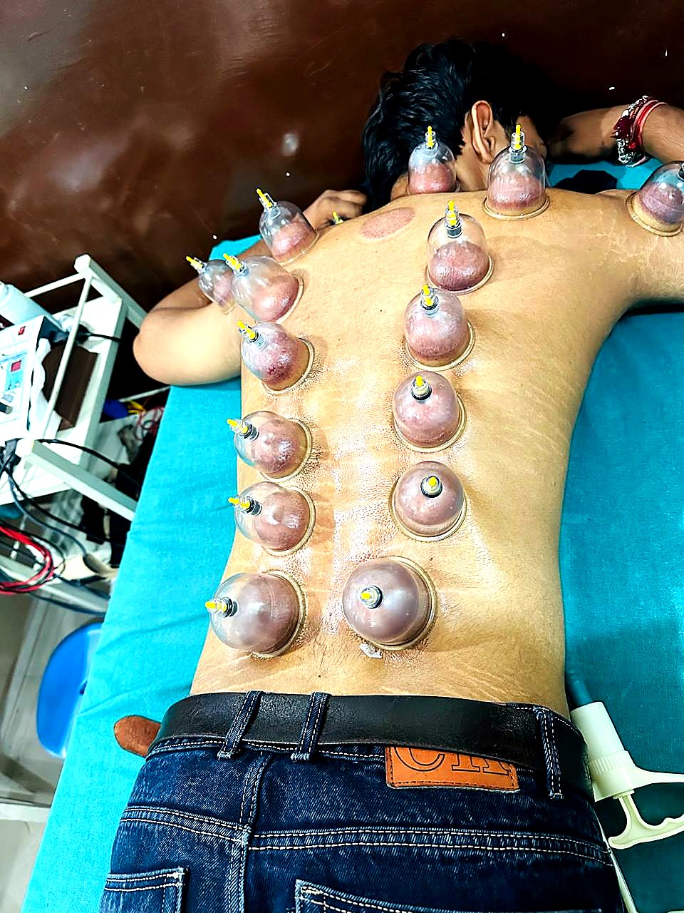 Vacuum Cupping Therapy Alwar